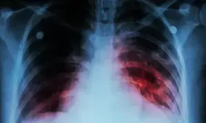 TB claimed 108 lives in Mizoram in 2023