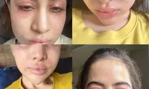 Uorfi Javed clarifies she has ‘major allergies’ and hasnt gone ‘overboard with fillers’