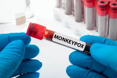 South Africa on high alert after five confirmed cases of monkeypox