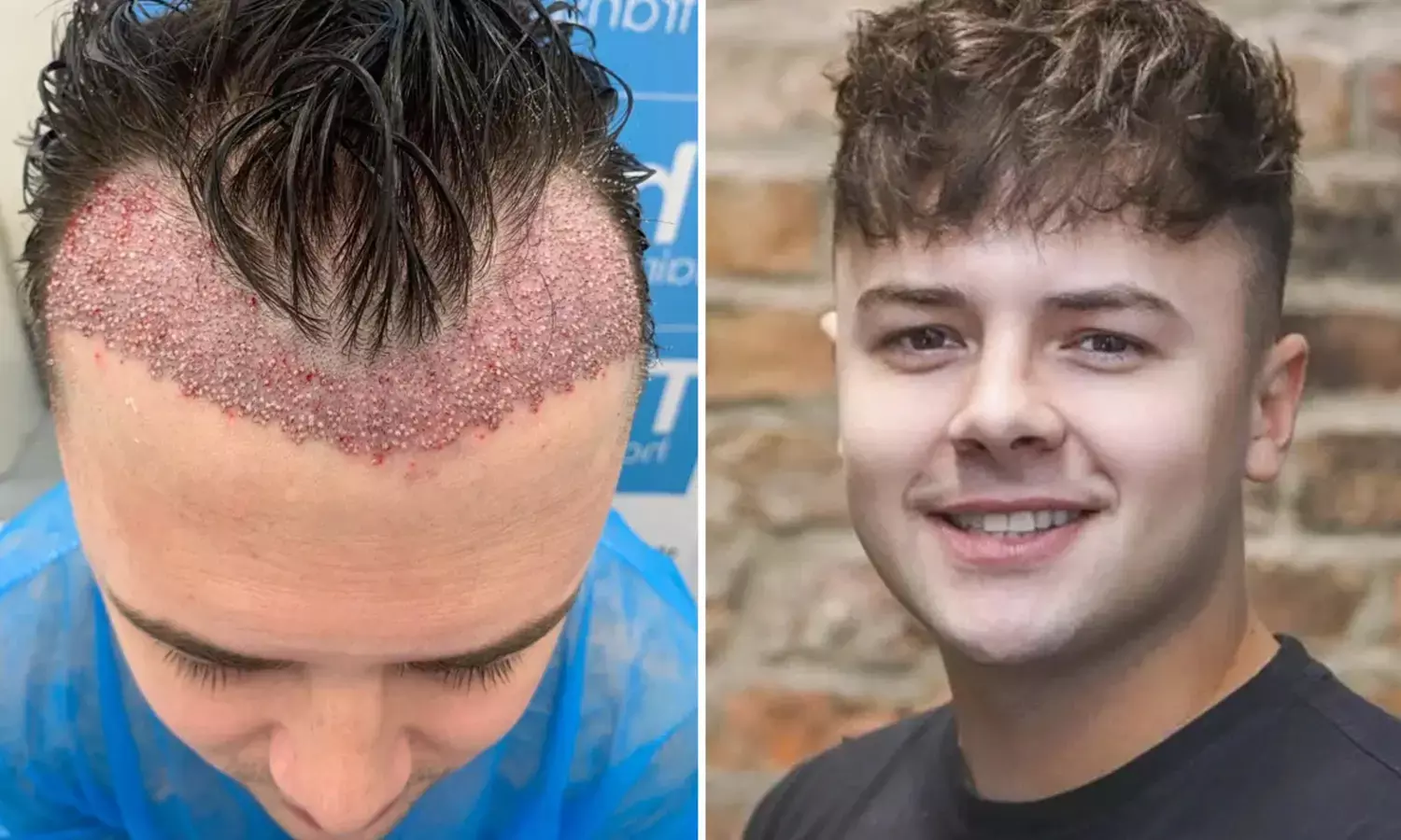 Turkey Emerges as Global Hair Transplant Hotspot