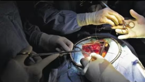 Doctors remove giant abdominal tumour bigger than a football weighing  7.5 kg
