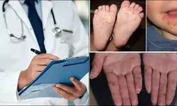 Hand, foot, mouth disease cases in Japan surge to decade high