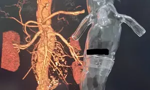 Bengaluru doctors treat Iraqi patient with 11cm large abdominal aneurysm
