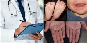 Hand, foot, mouth disease cases in Japan surge to decade high Hand, foot, mouth disease cases in Japan surge to decade high