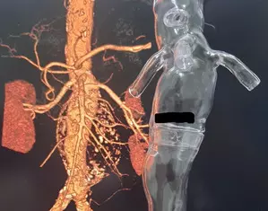 Bengaluru doctors treat Iraqi patient with 11cm large abdominal aneurysm