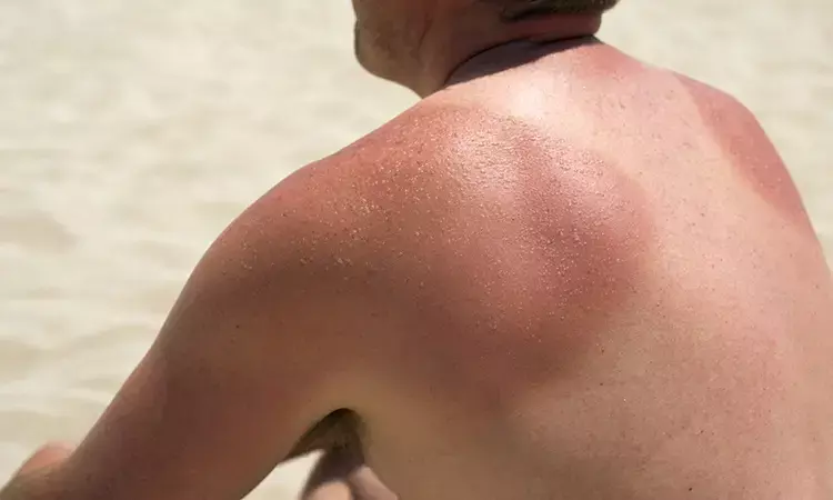 Beating the Heat: Effective Home Remedies for Sunburn Relief