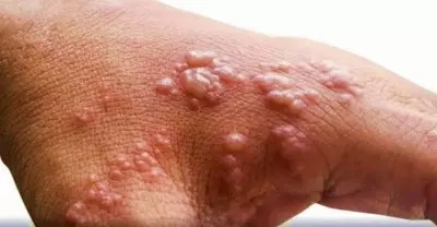 Africa CDC declares mpox public health emergency as cases surge
