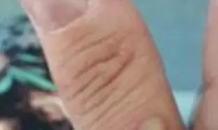 Three mpox cases detected, health facilities on high alert in Pakistan