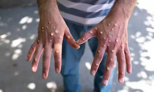 WHO Declares Ampox a Global Public Health Emergency as Cases Surge Worldwide