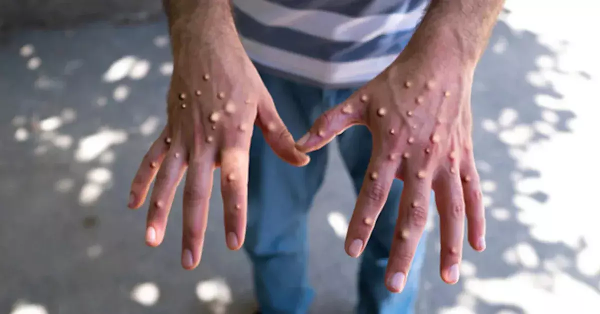WHO Declares Ampox a Global Public Health Emergency as Cases Surge Worldwide WHO Declares Ampox a Global Public Health Emergency as Cases Surge Worldwide