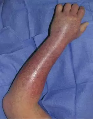 Bengaluru doctors save 25-year-old mother suffering from acute liver failure Bengaluru doctors save 25-year-old mother suffering from acute liver failure