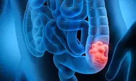 Rising Colon Cancer Cases Among Young Adults: Causes, Symptoms, and Prevention
