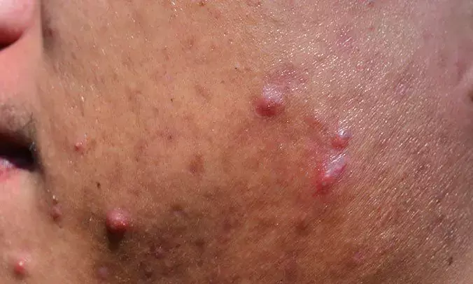 7 Natural Home Remedies to Combat Summer Acne and Pimples