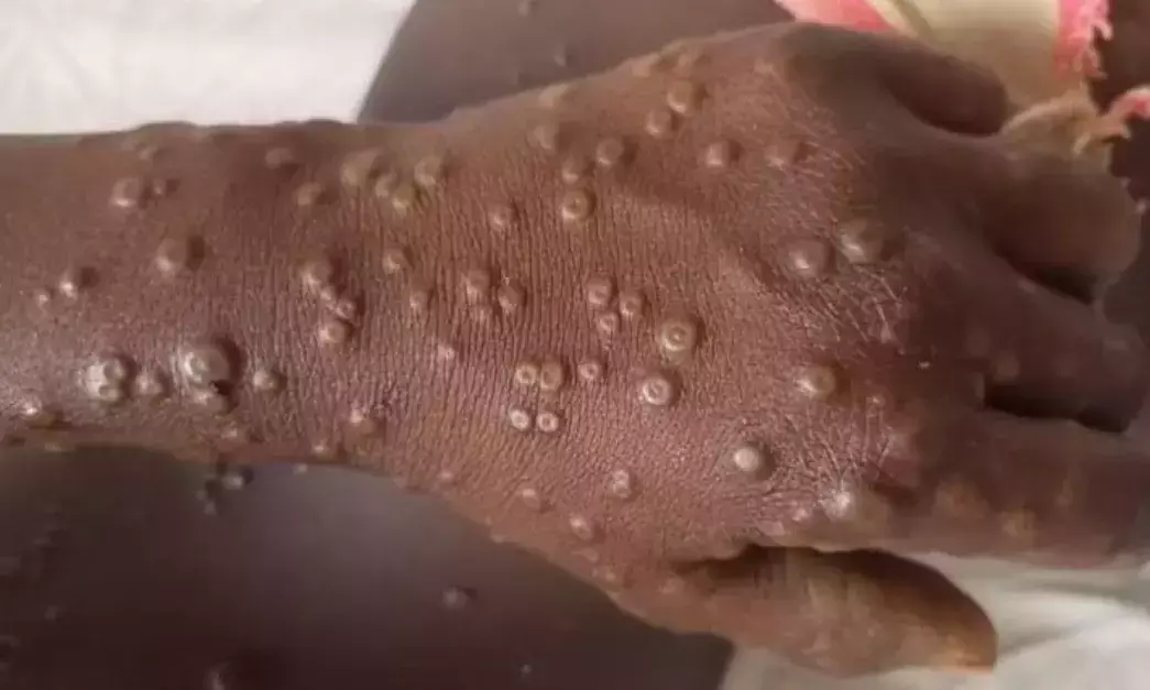 India’s First Case of Mpox Clade 1b Variant Reported: Know What is Mpox and How Dangerous is It