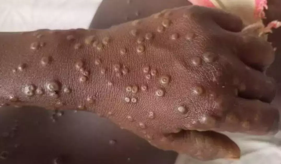 India’s First Case of Mpox Clade 1b Variant Reported: Know What is Mpox and How Dangerous is It India’s First Case of Mpox Clade 1b Variant Reported: Know What is Mpox and How Dangerous is It