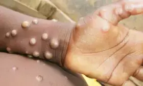 Kenyas mpox cases rise to seven