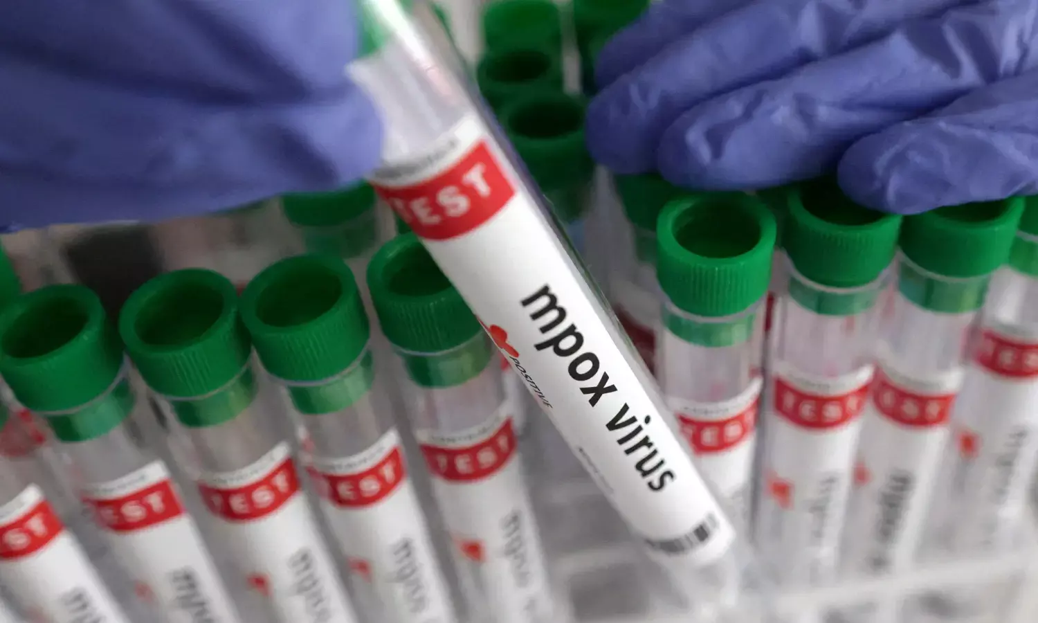 Third Mpox Case Reported in India, Kerala Intensifies Efforts to Contain Virus