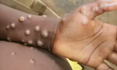 Africa CDC calls for enhanced surveillance, detection as monkeypox cases surpass 32,400