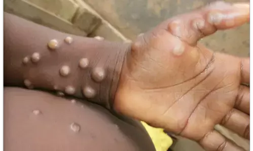 Death toll from monkeypox in Africa nears 1,000 as cases exceed 38,000