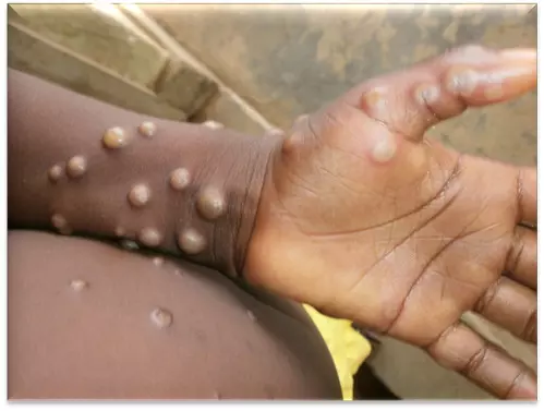 Death toll from monkeypox in Africa nears 1,000 as cases exceed 38,000 Death toll from monkeypox in Africa nears 1,000 as cases exceed 38,000