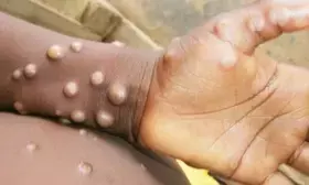Uganda reports 49 new mpox cases
