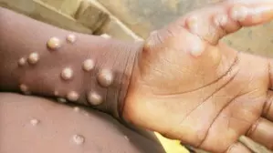 Uganda reports 49 new mpox cases Uganda reports 49 new mpox cases