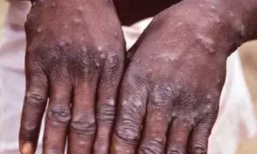 Ugandas health ministry warns of increasing monkeypox cases