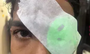 21 patients, largely minors, reported at PGI Chandigarh with firecracker injuries