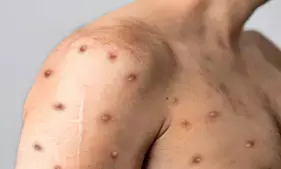 US confirms first case of clade I mpox in California