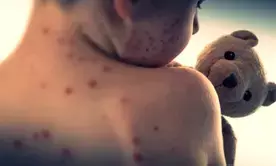 Vietnams Ho Chi Minh City reports surging measles infections among children