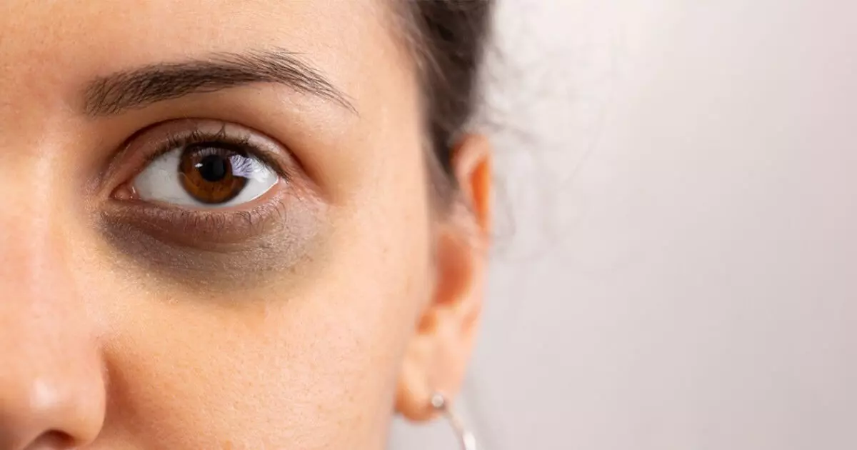 Do you look tired and aged because of dark circles? Try these simple home remedies and get glowing eyes! Do you look tired and aged because of dark circles? Try these simple home remedies and get glowing eyes!
