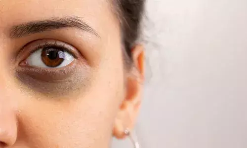 Do you look tired and aged because of dark circles? Try these simple home remedies and get glowing eyes!