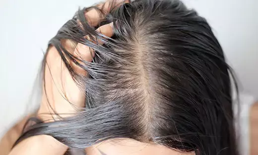 Get rid of hair fall problems in winter season; know these home remedies