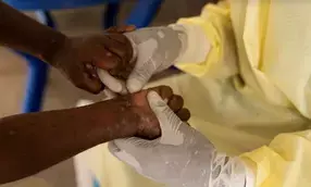 Mpox situation in Africa remains especially concerning: WHO