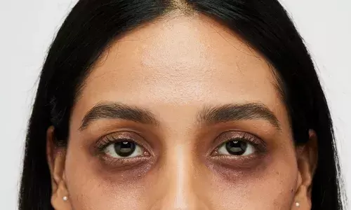 Are you troubled by dark circles? Try these easy home remedies to get rid of them naturally