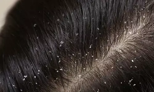 Are you troubled by dandruff during the winter? Follow these simple and effective home remedies to get rid of it