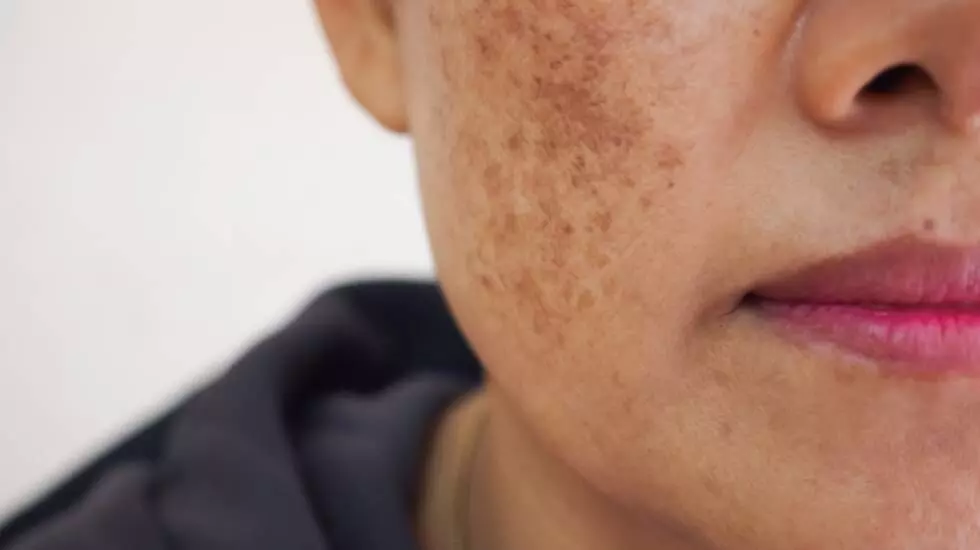 Skincare Tips: Troubled by freckles on your face? 5 home remedies to get rid of it Skincare Tips: Troubled by freckles on your face? 5 home remedies to get rid of it