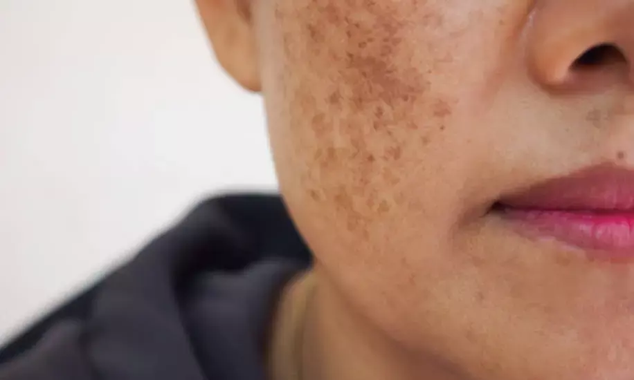 Skincare Tips: Troubled by freckles on your face? 5 home remedies to get rid of it