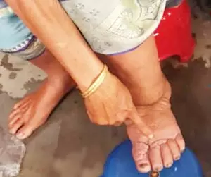 Gujarat to administer anti-filariasis drugs to 5.46 lakh people