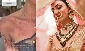 Priyanka Chopras bhabhi Neelam Upadhyaya suffers burns on her skin