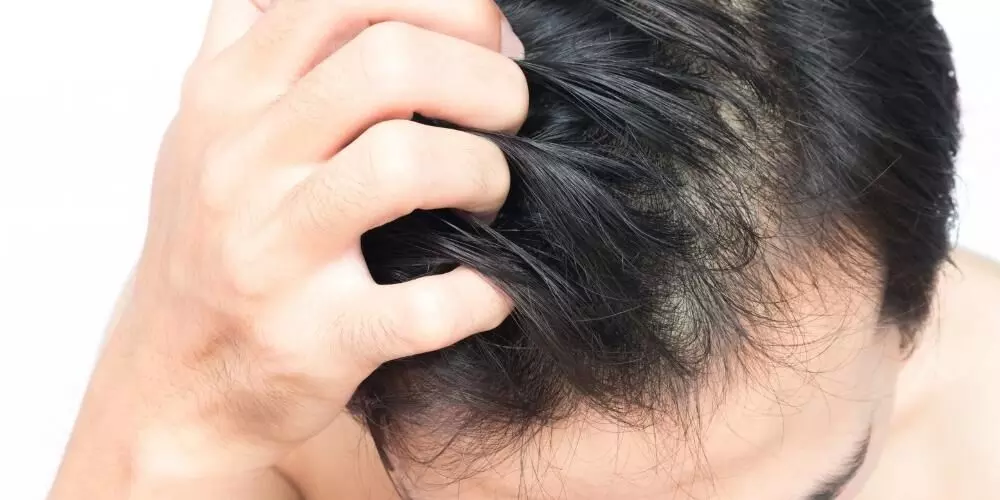 Get rid of hair fall: Include these 5 things in your diet for healthy and thick hair Get rid of hair fall: Include these 5 things in your diet for healthy and thick hair