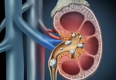 Prevent the risk of kidney stones: Adopt these habits with a healthy lifestyle and proper diet