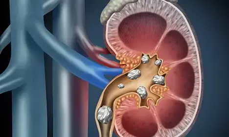 Prevent the risk of kidney stones: Adopt these habits with a healthy lifestyle and proper diet