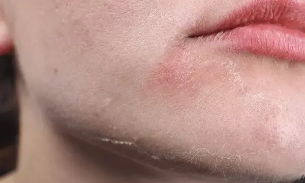 Skincare alert for dry skin people: Avoid using these things