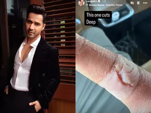 Varun Dhawan suffers injury, shows off deep cut on his finger Varun Dhawan suffers injury, shows off deep cut on his finger