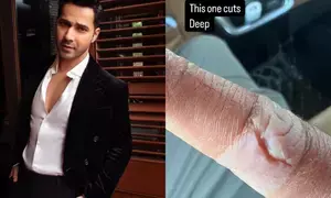 Varun Dhawan suffers injury, shows off deep cut on his finger Varun Dhawan suffers injury, shows off deep cut on his finger