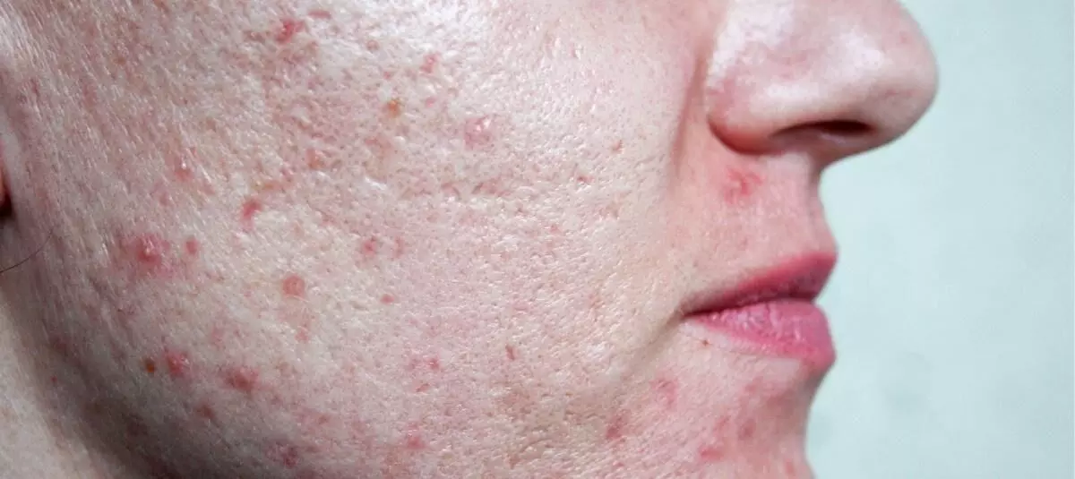 Is oily skin and pimples affecting the beauty of face? Adopt these tips to get rid of the problem! Is oily skin and pimples affecting the beauty of face? Adopt these tips to get rid of the problem!