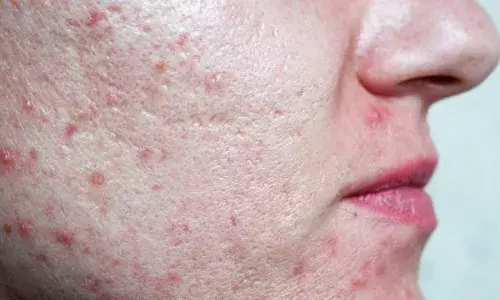Is oily skin and pimples affecting the beauty of face? Adopt these tips to get rid of the problem!