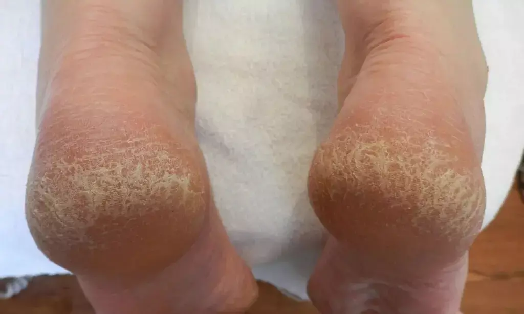 Are you troubled by cracked heels? Try these home remedies for instant relief