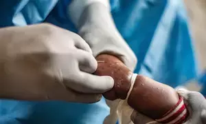 Mpox deaths reach 260 in Africa as humanitarian crisis in Congo hampers response Mpox deaths reach 260 in Africa as humanitarian crisis in Congo hampers response